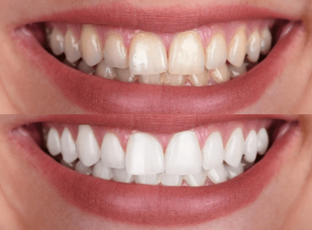 tanden bleken Nieuwegein